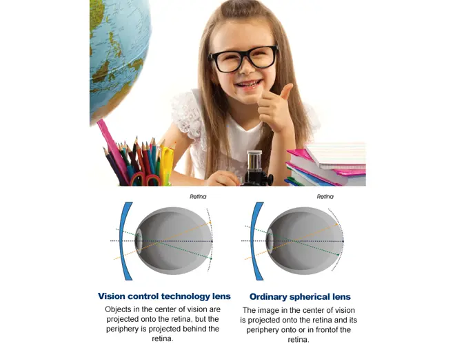 lentes de desenfoque periférico myovision-defocus-niños-control-de-miopía-lente-monofocal-1