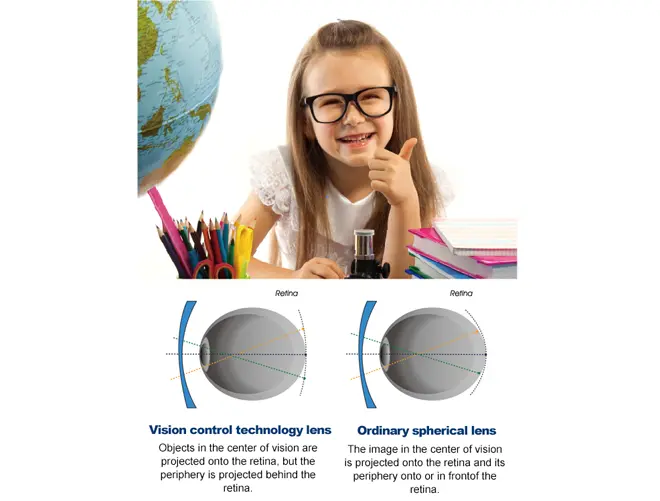 Especificación de la lente monofocal de control de miopía infantil con desenfoque periférico